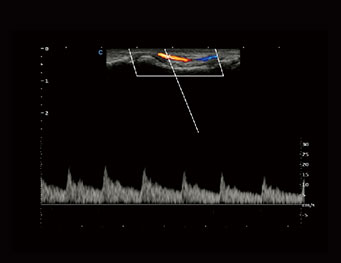 指尖血流，PW 模式