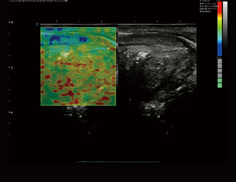 前列腺，弹性成像