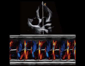 心尖四腔心， 彩色M模式