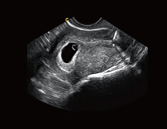 早孕，B 模式