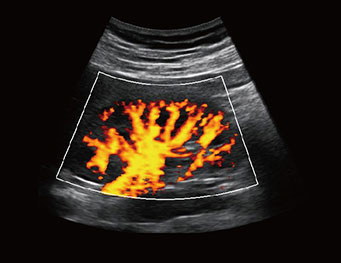 肾脏，PD 模式