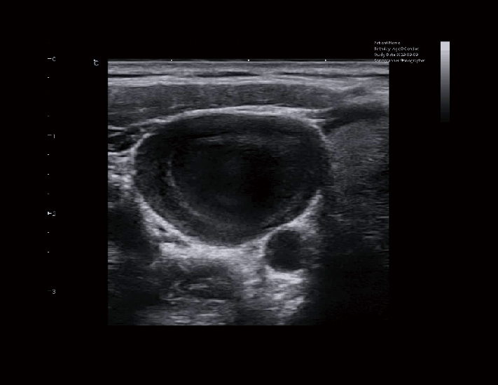 颈部包块，B模式