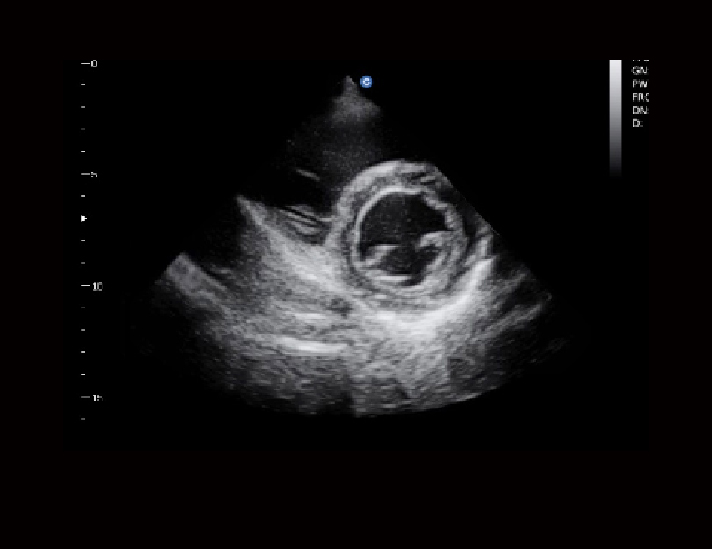 心脏，B模式