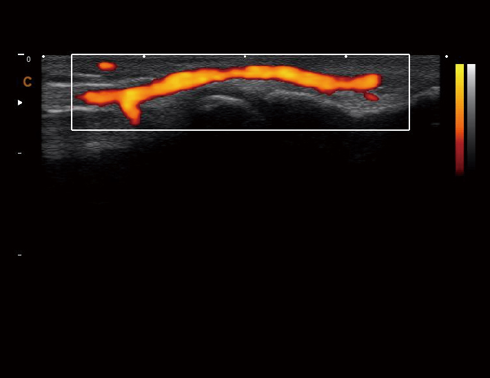 浅表血管，C模式