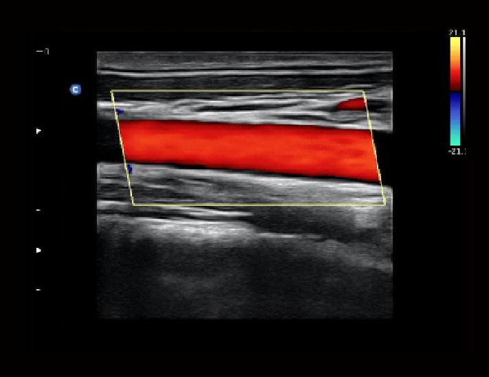 血管，C模式
