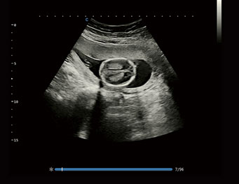 Fetus，B Mode