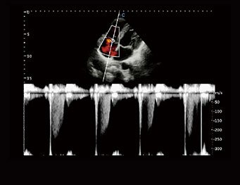TV，Regurgitation，C Mode