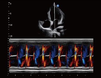 Apical Four Chambers, Color M Mode